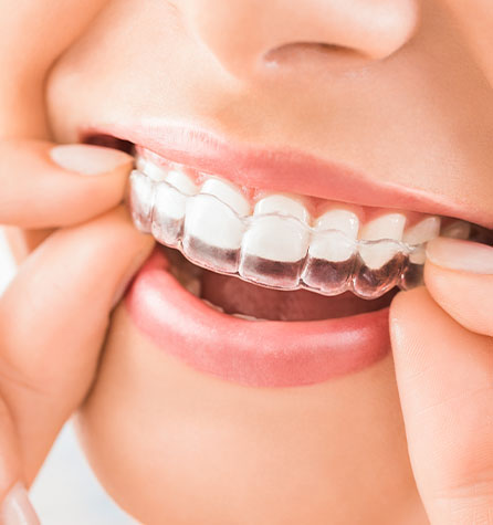 Invisalign, Arch King West Dental