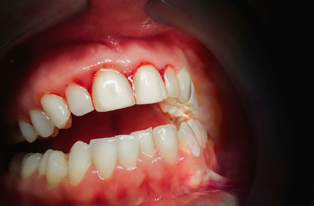 A close-up of a mouth showing bleeding gums due to Gingivitis.