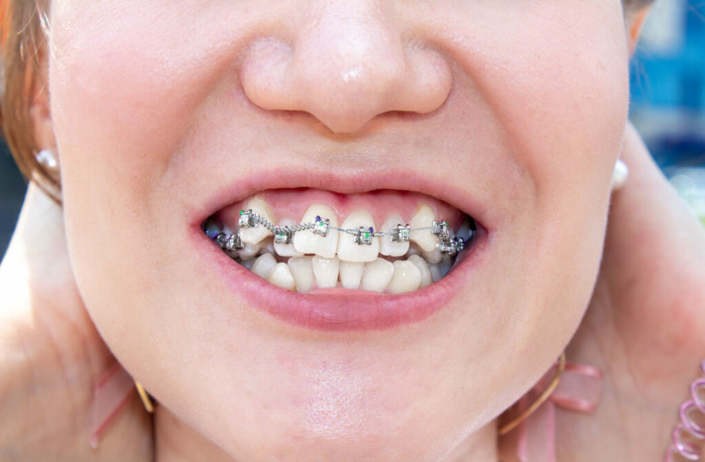 A close-up crooked teeth of young woman with braces to correct her teeth alignment