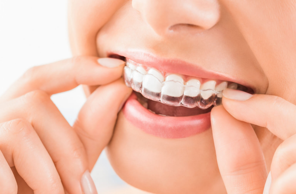 A woman wearing an orthodontic silicone trainer, an invisible braces aligner.