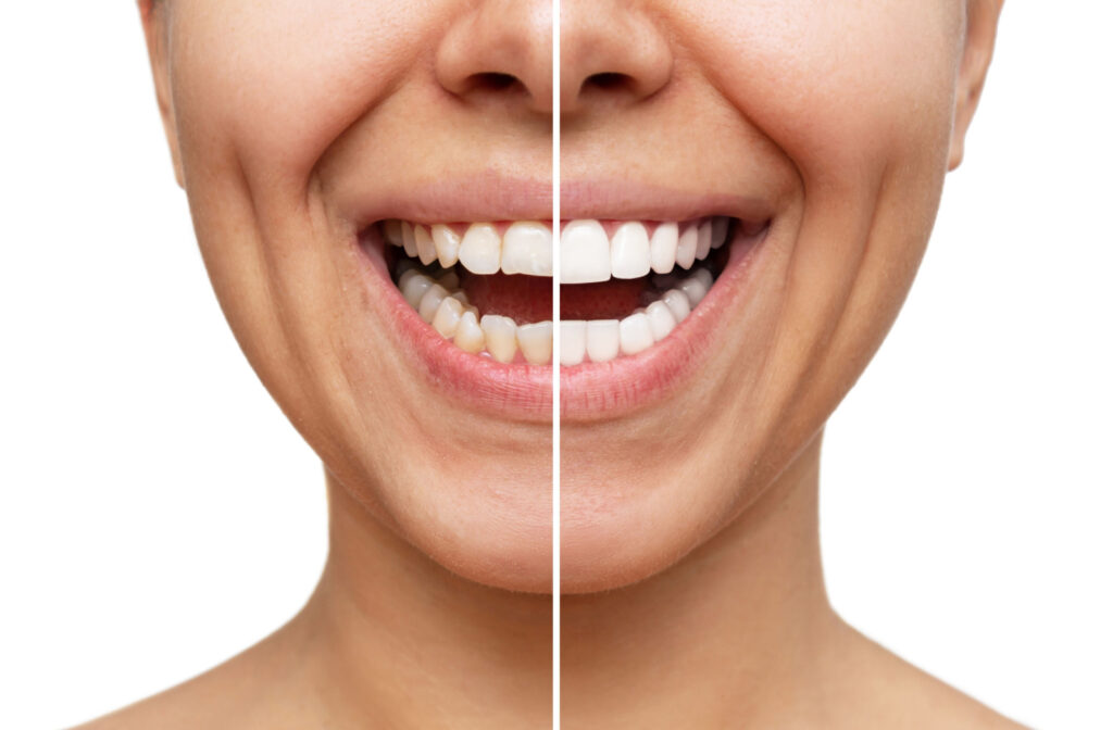 a before and after close up of a woman with veneers. the before shows her teeth as more crooked than the after, with veneers