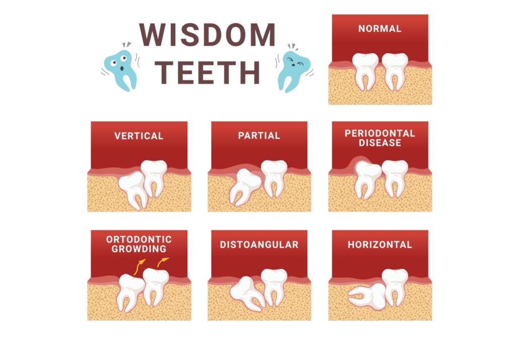 Image showing the different orientations of impacted wisdom teeth.