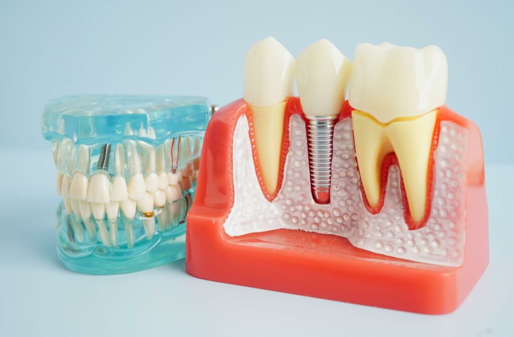 A model of a dental implant sits next to a model of human teeth.