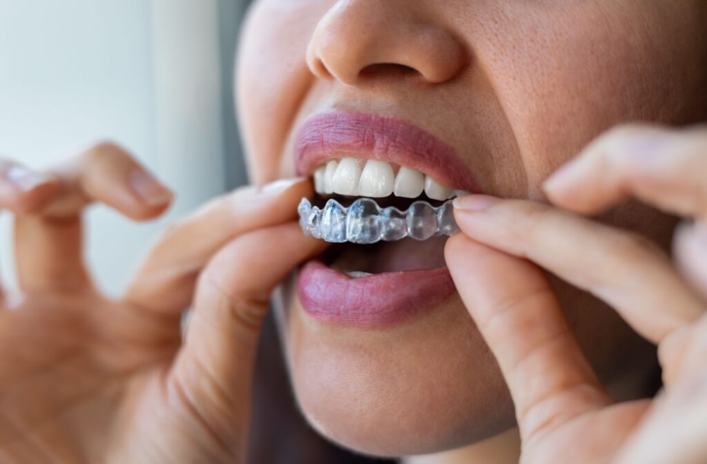 A close-up of a woman's invisalign aligner.