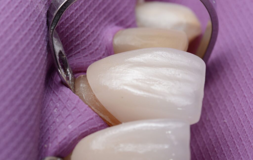 A dentist carefully places a veneer on top of a person's tooth with an adhesive resin.