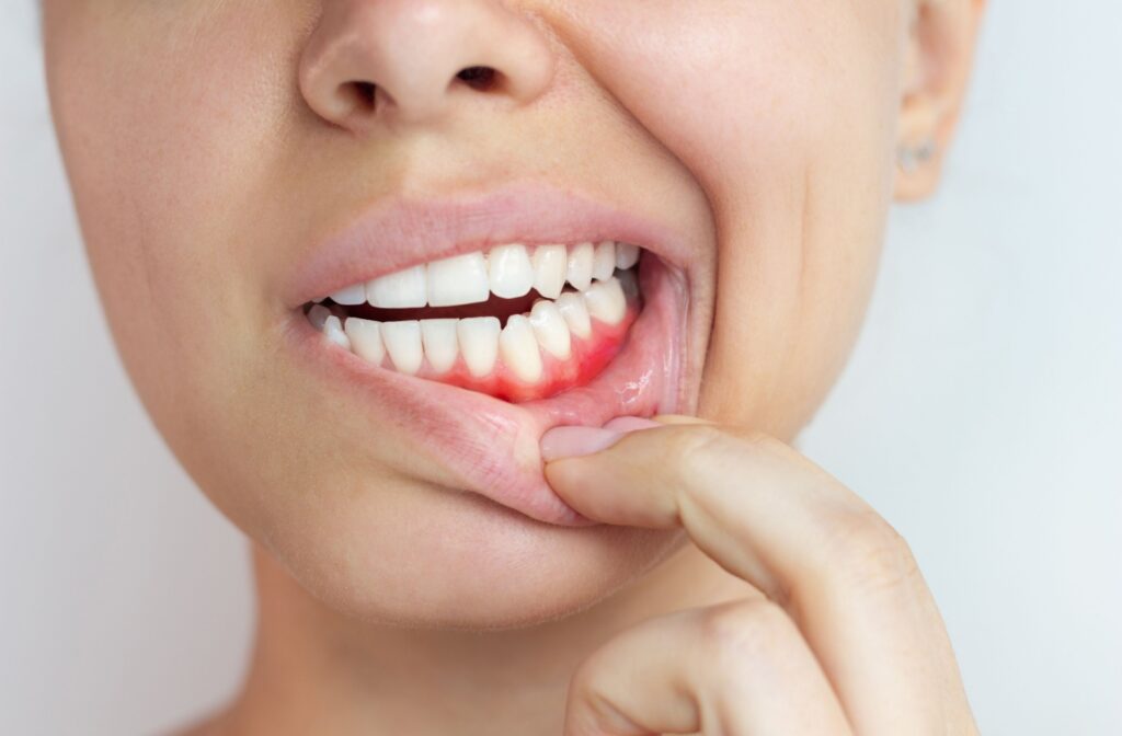 A close-up of a person pulling down their lower lip to show red, inflamed gums around their lower front teeth.