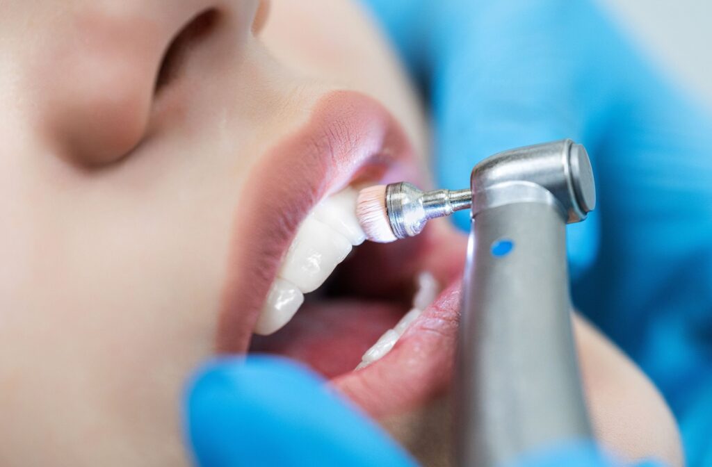 Dentist using a polishing tool on a patient’s teeth during a professional dental cleaning procedure.