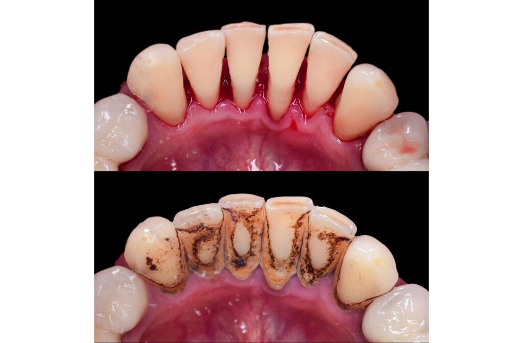Close-up of lower front teeth showing tartar buildup before dental cleaning and clean teeth after professional cleaning.