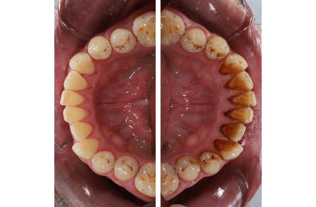 Top-down view of lower teeth showing heavy tartar buildup before cleaning and clean, polished enamel after professional dental scaling.