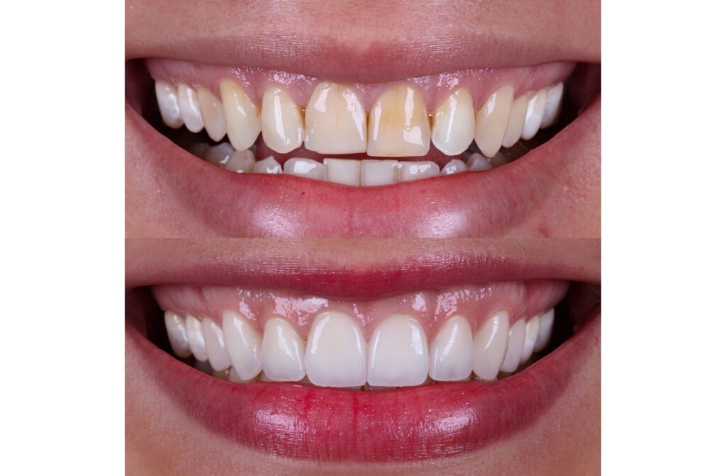 Close-up comparison of a person’s smile showing teeth before and after whitening treatment, highlighting improved brightness and color uniformity.