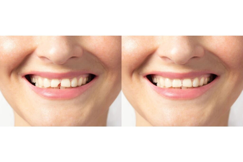Side-by-side comparison of a smile before and after repairing a chipped front tooth, showing improved tooth appearance.