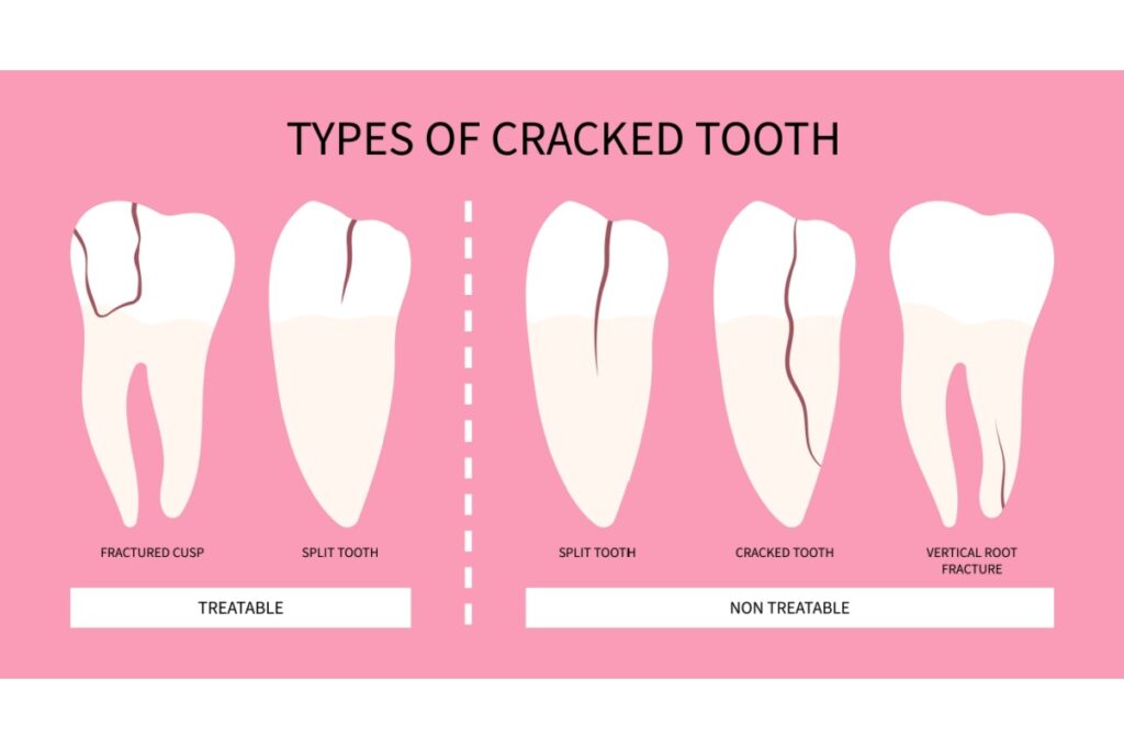 Diagram of different types of cracked teeth including fractured cusp, split tooth, cracked tooth, and vertical root fracture, with labels showing which are treatable.