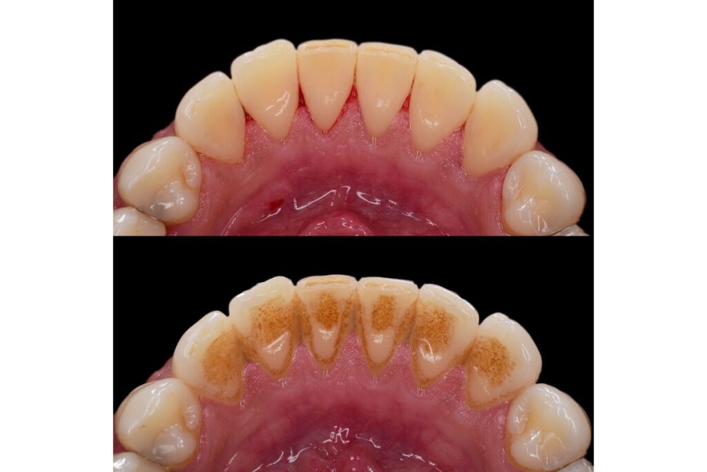 Before and after view of tartar removal on teeth.