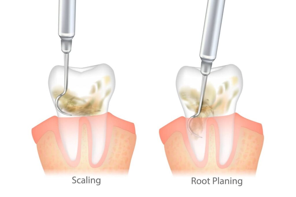 Illustration showing difference between scaling and root planing.