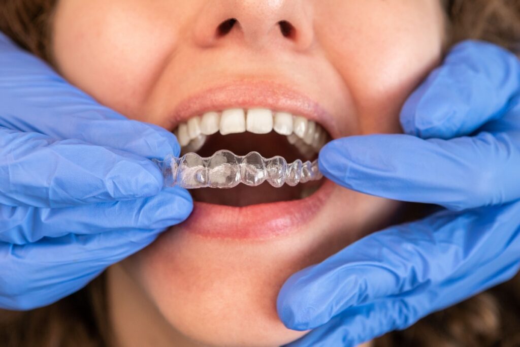 dentist placing invisalign tray onto female patients top teeth.